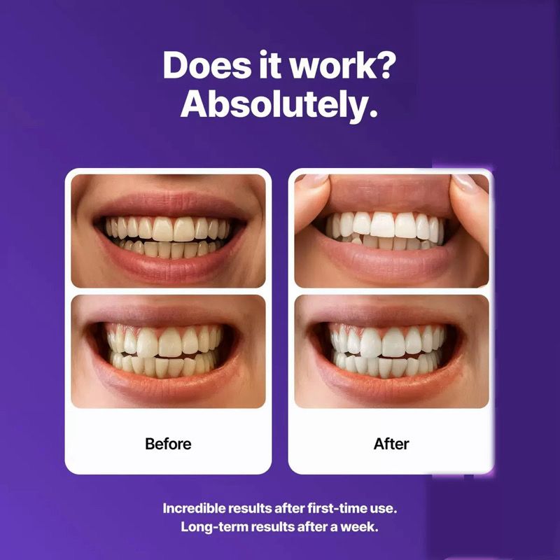 M.Smile Professional Teeth Whitening Strips – Instant Results After One Use